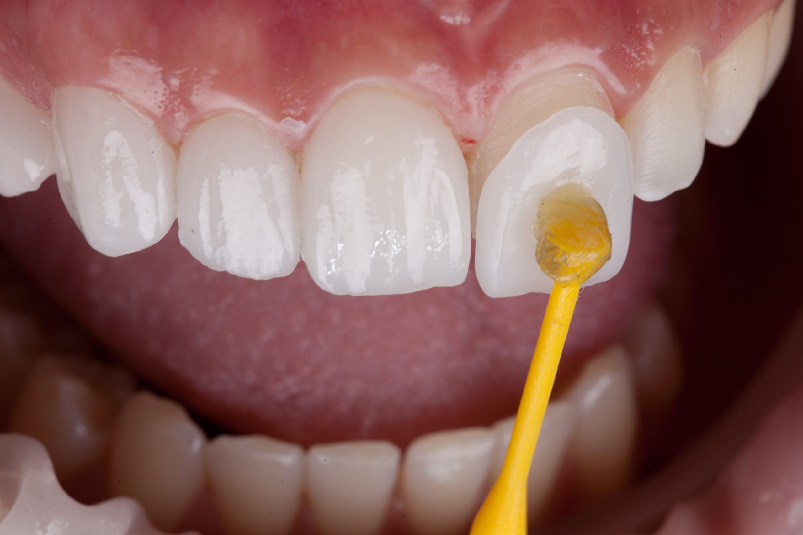 Veneer Bonding Price in Vietnam – Cost Breakdown, Value, and Dental Standards