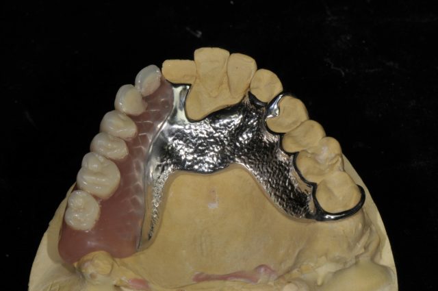 denture made by dentist in da nang