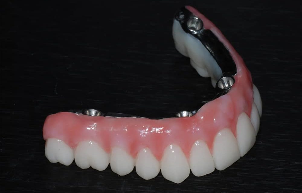 All on 4 Dental Implants Da Nang