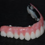 All on 4 implant with crowns, pink gums, and Titan bars.