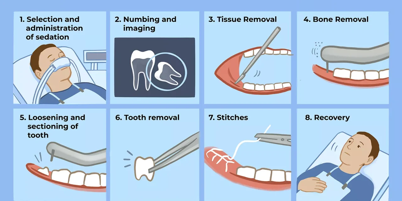 Painless Wisdom Tooth Removal in Da Nang