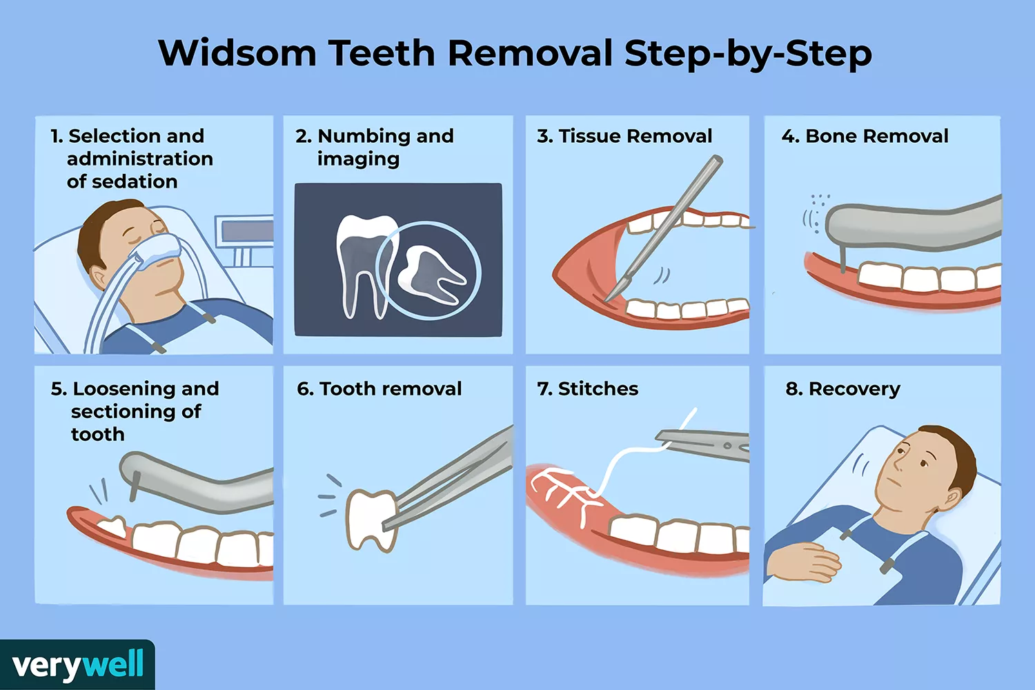 Wisdom Teeth Removal Procedure in da nang