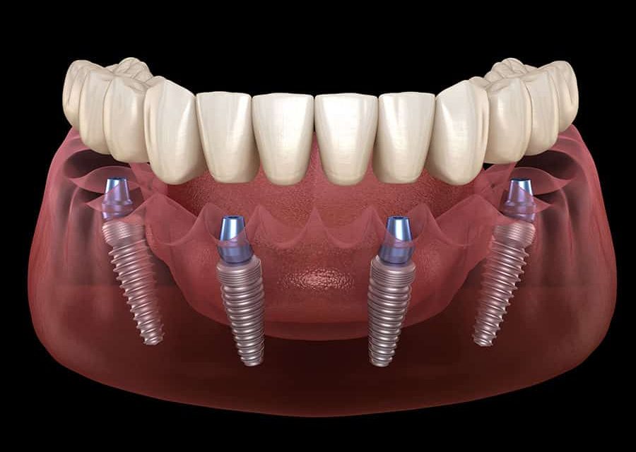 Full Mouth Dental Implants in Da Nang