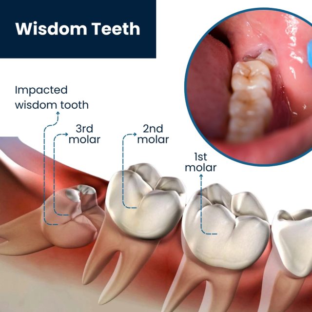 wisdom tooth should be remove